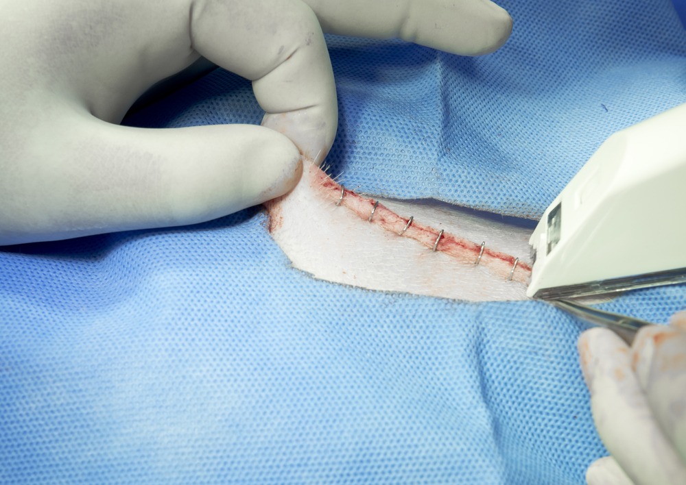 Surgical Staplers Lawsuits